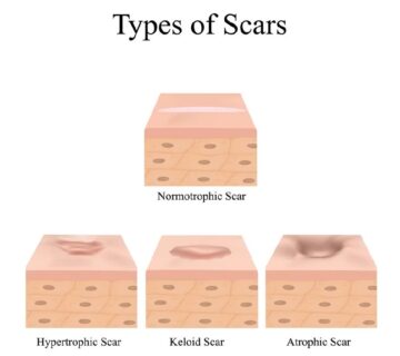 scar is an incomplete repair